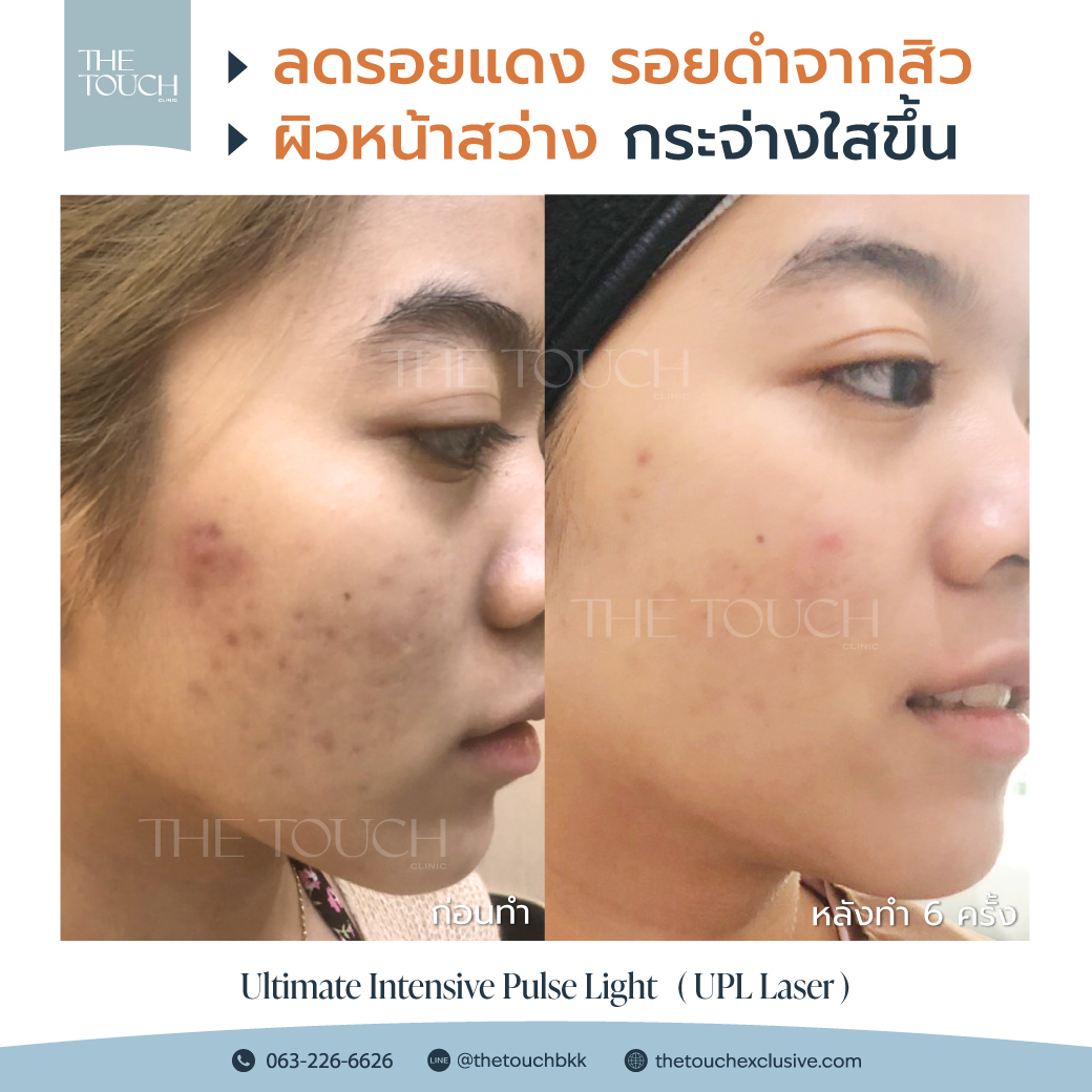 review-upl-ultimate-intensive-pulse-light