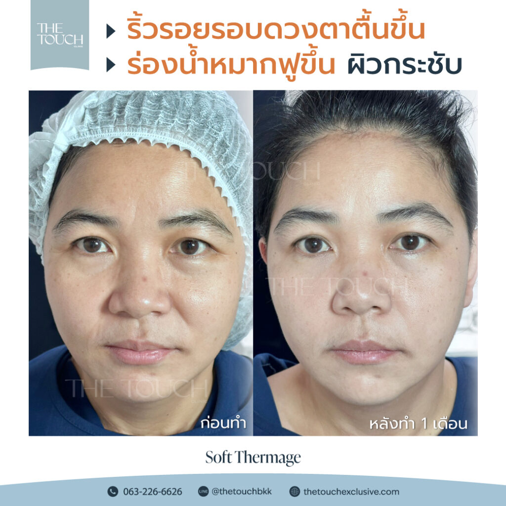 review-soft-thermage