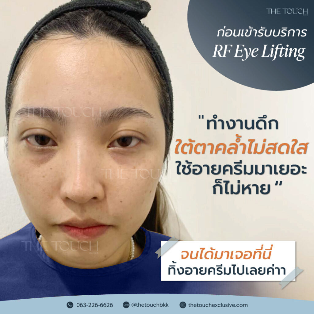 review-rf-eye-lifting