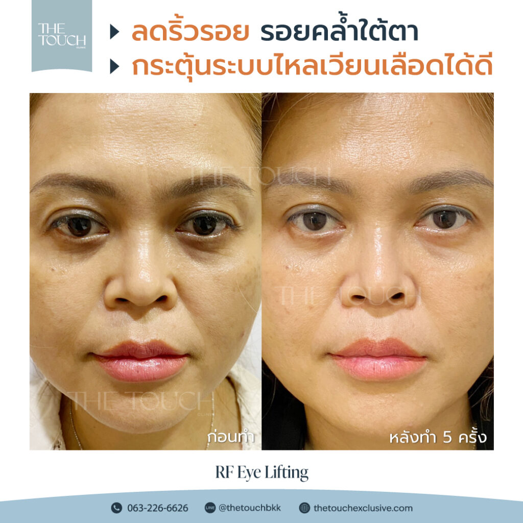 review-rf-eye-lifting