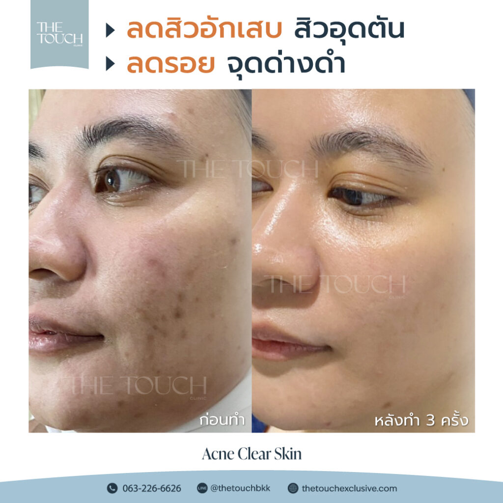 review-acne-clear-skin