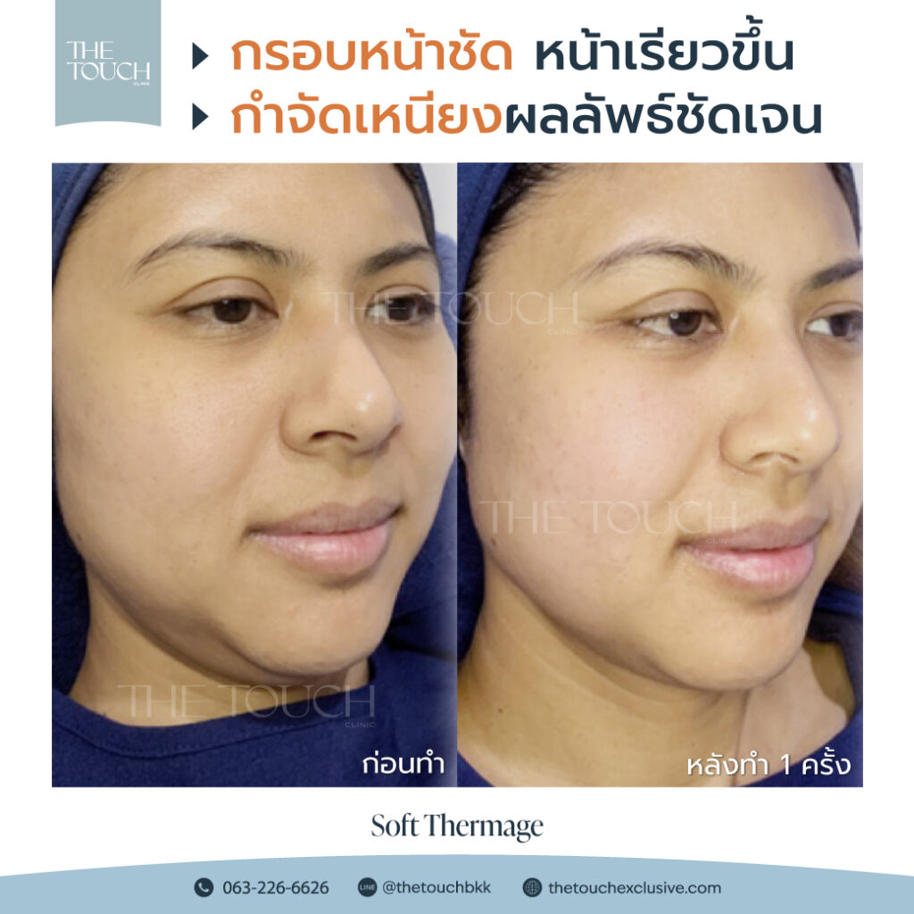 review-soft-thermage