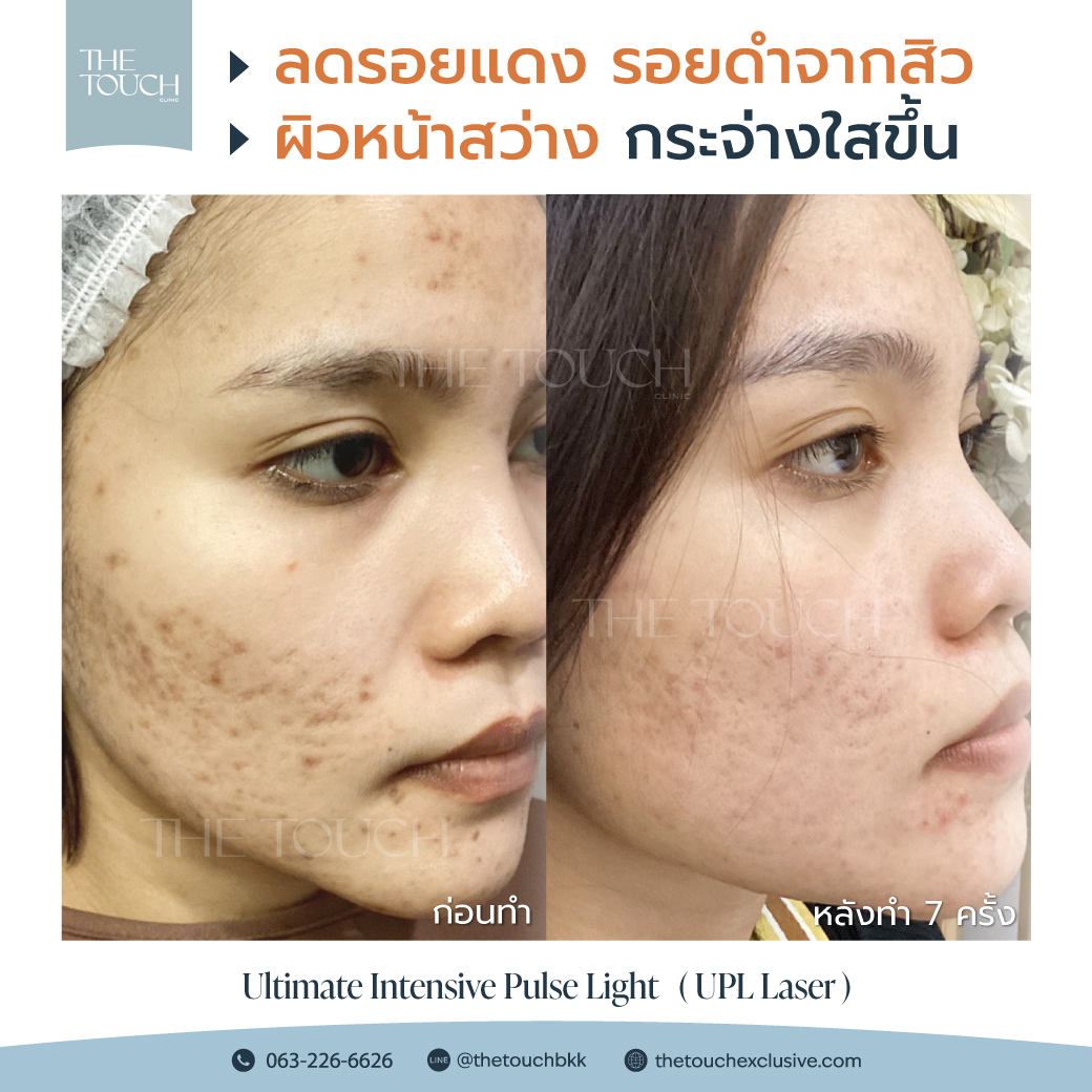 review-upl-ultimate-intensive-pulse-light
