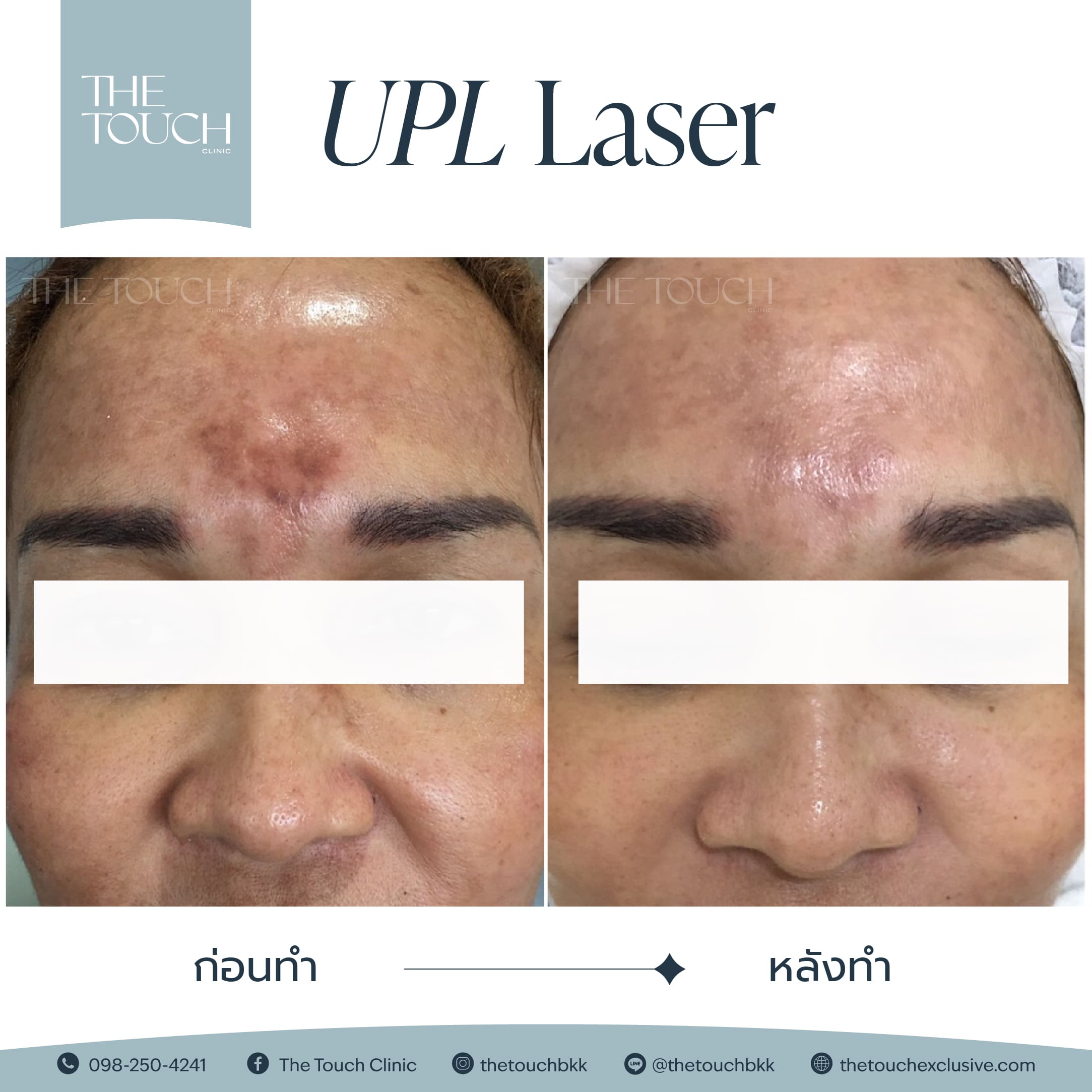 review-upl-ultimate-intensive-pulse-light