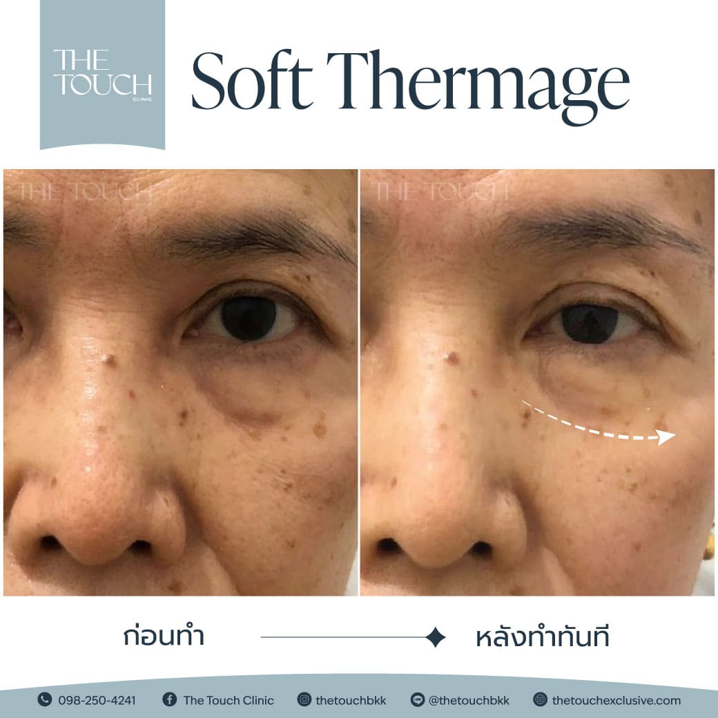 review-soft-thermage