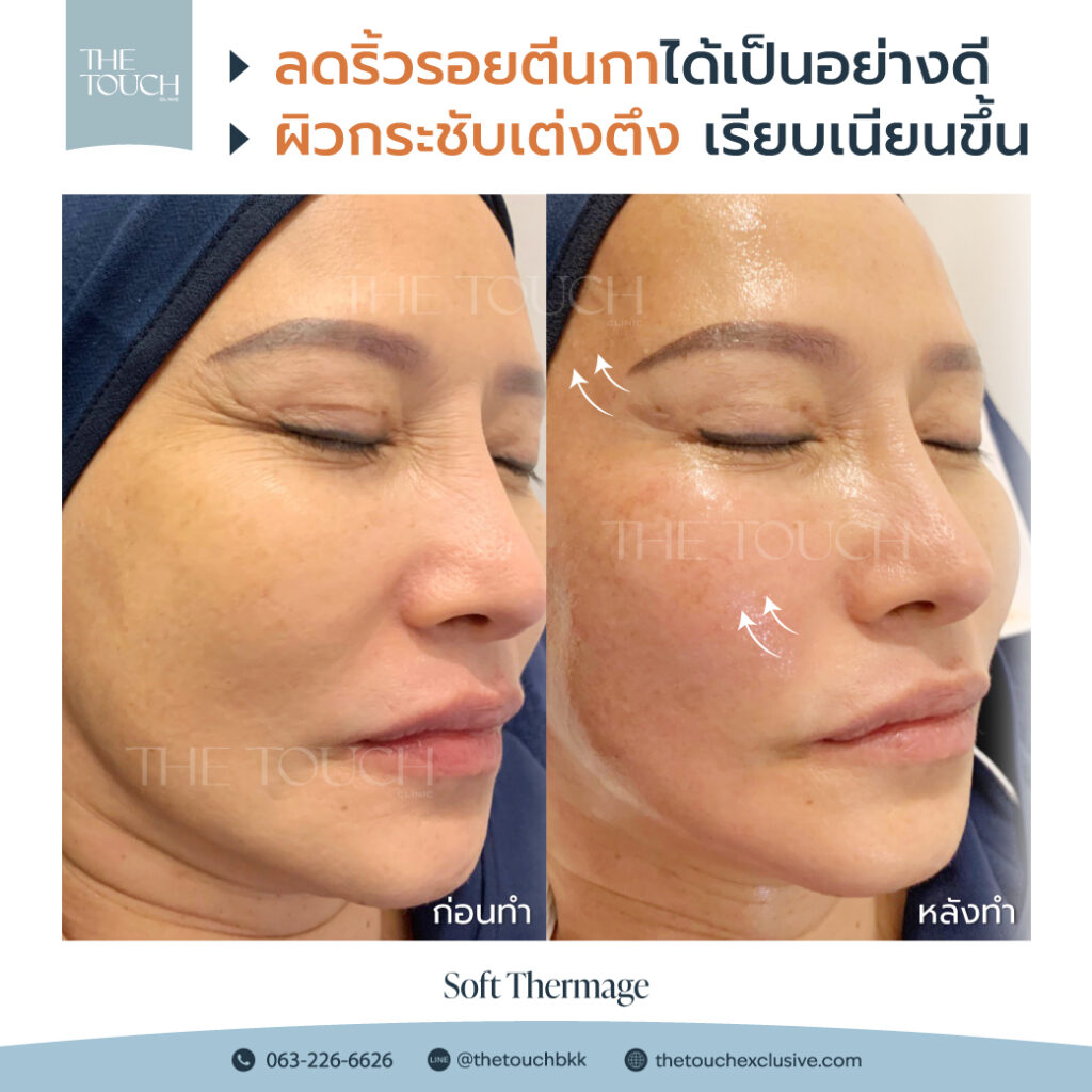 review-soft-thermage