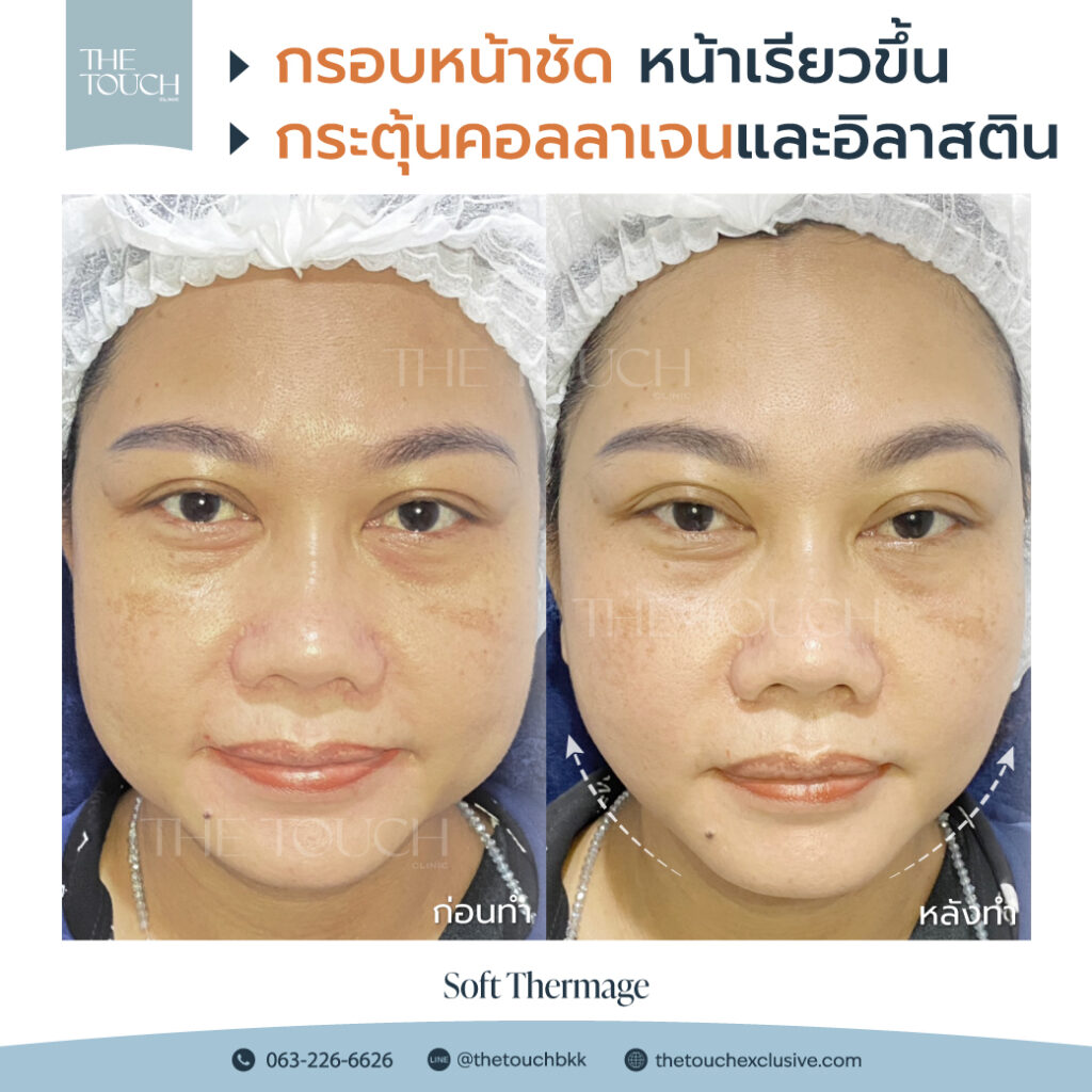 review-soft-thermage