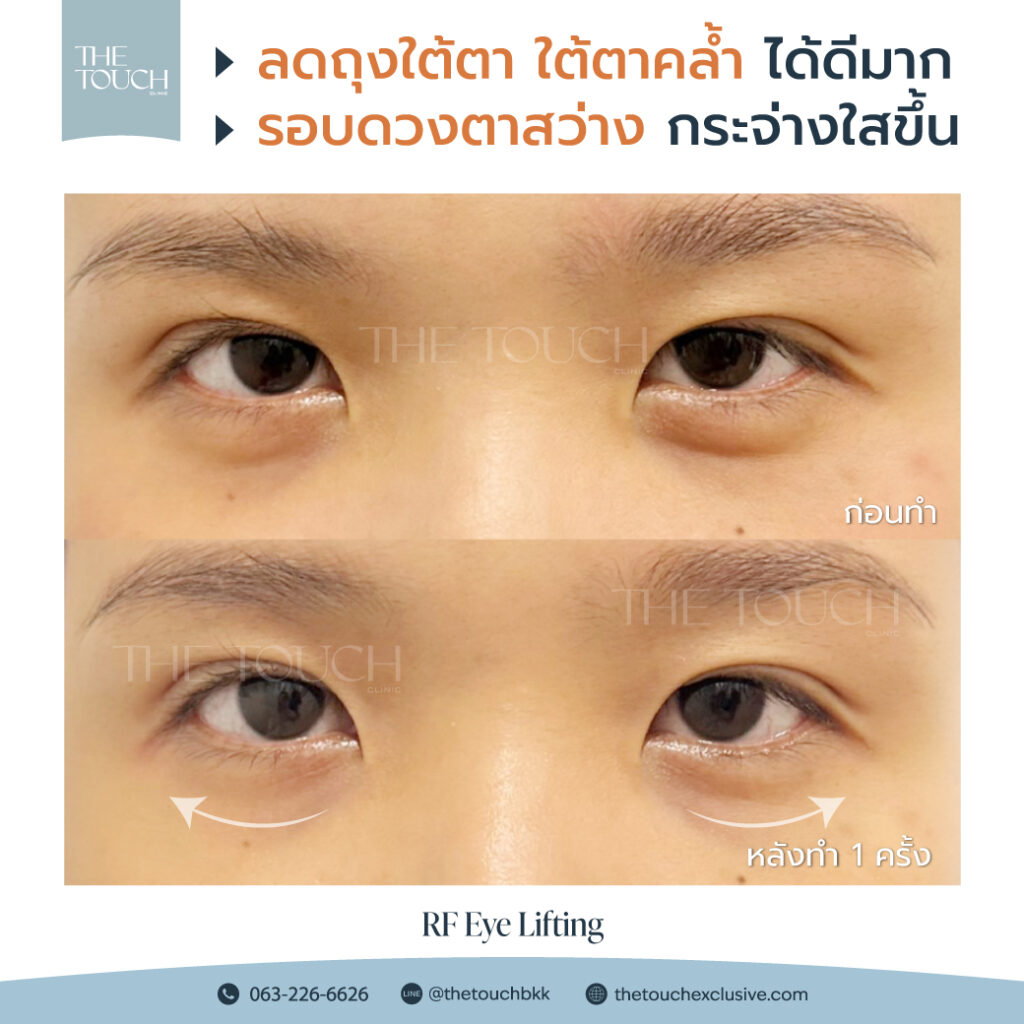 review-rf-eye-lifting