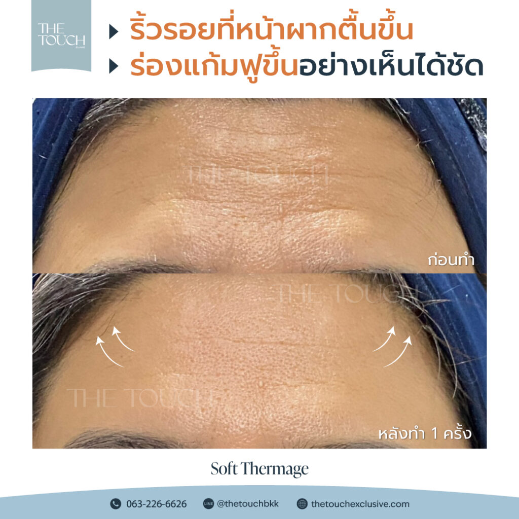 review-soft-thermage