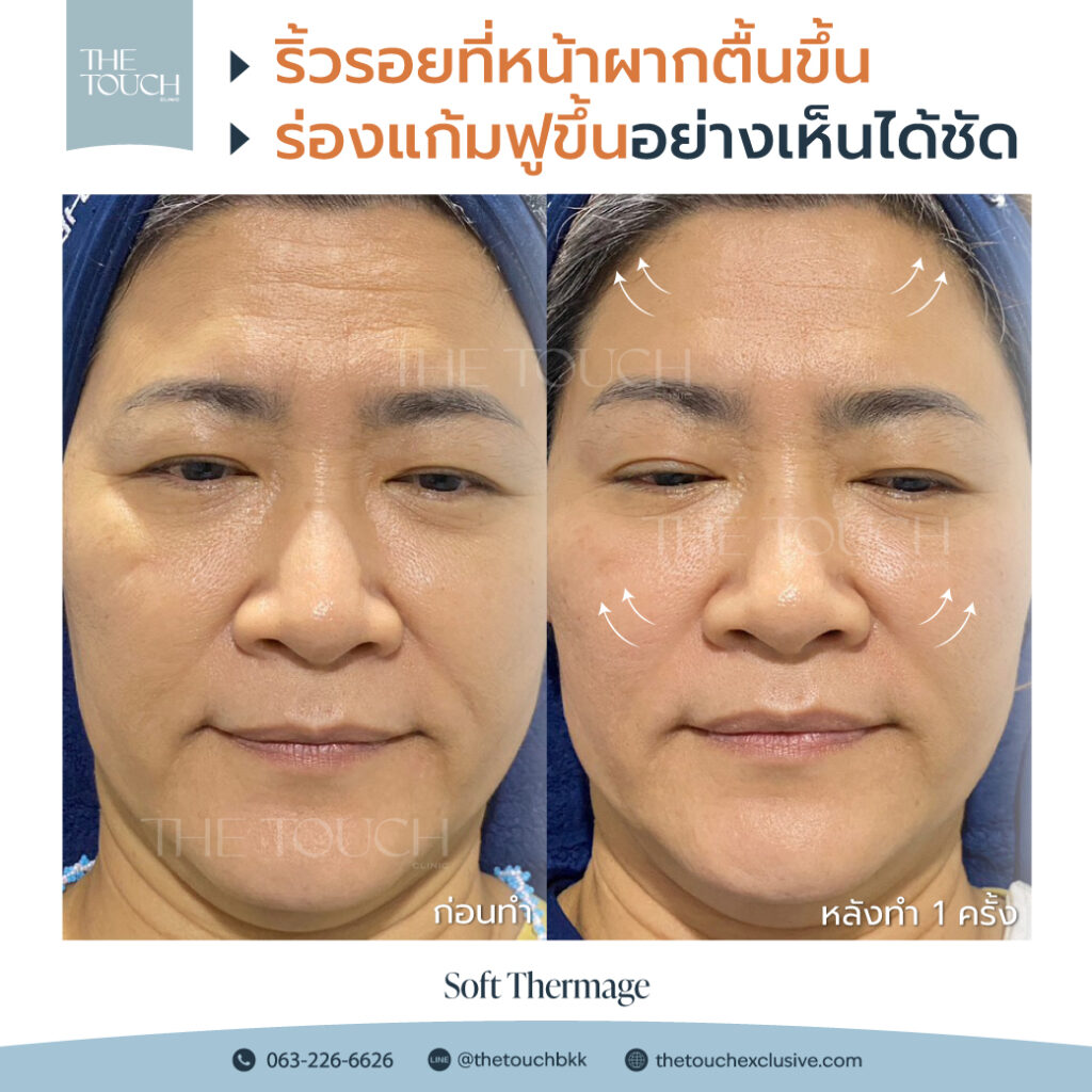 review-soft-thermage