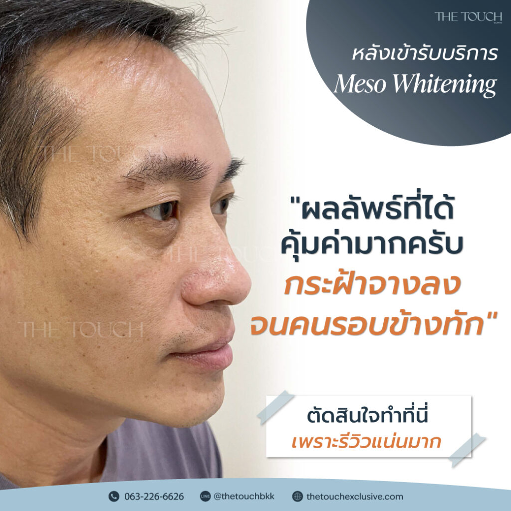 review-meso-whitening