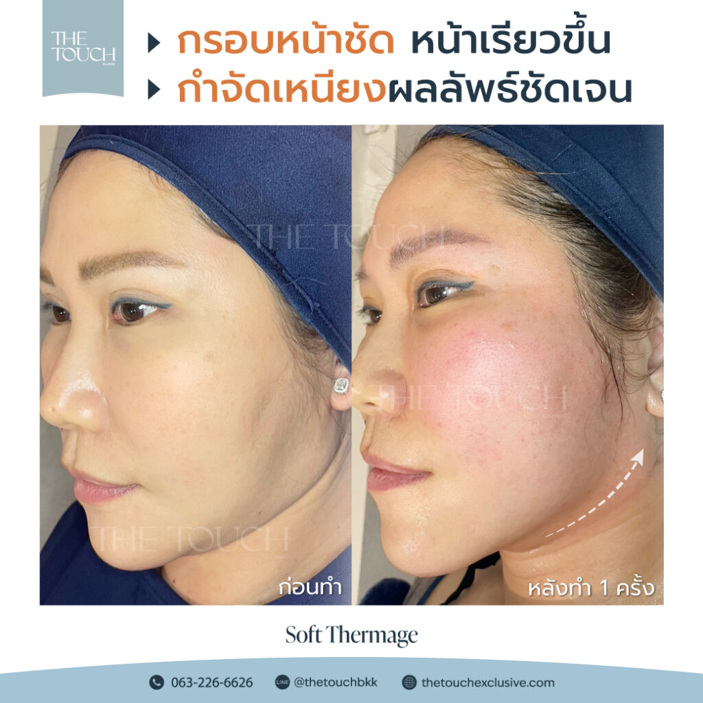 review-soft-thermage