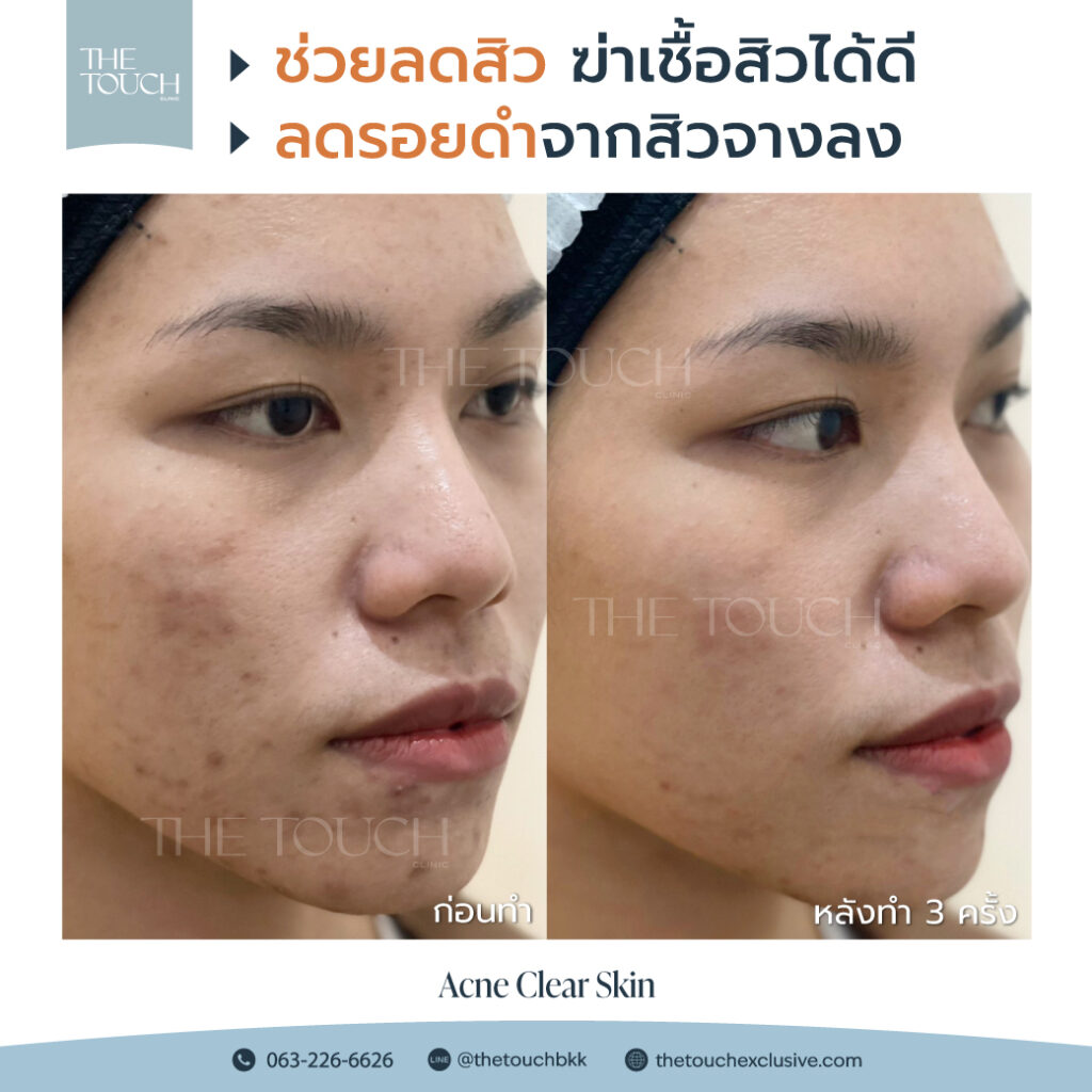 review-acne-clear-skin