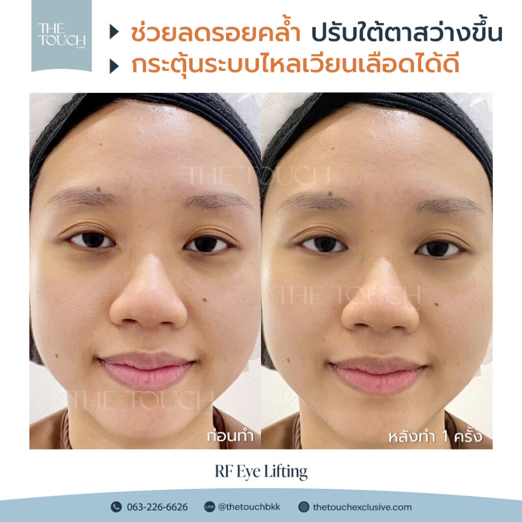 review-rf-eye-lifting