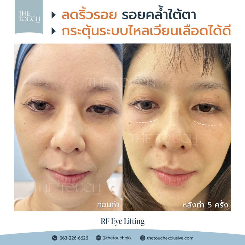 review-rf-eye-lifting