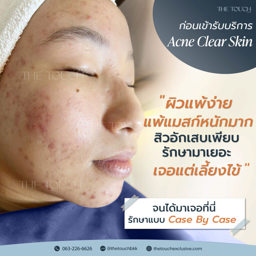 review-acne-clear-skin