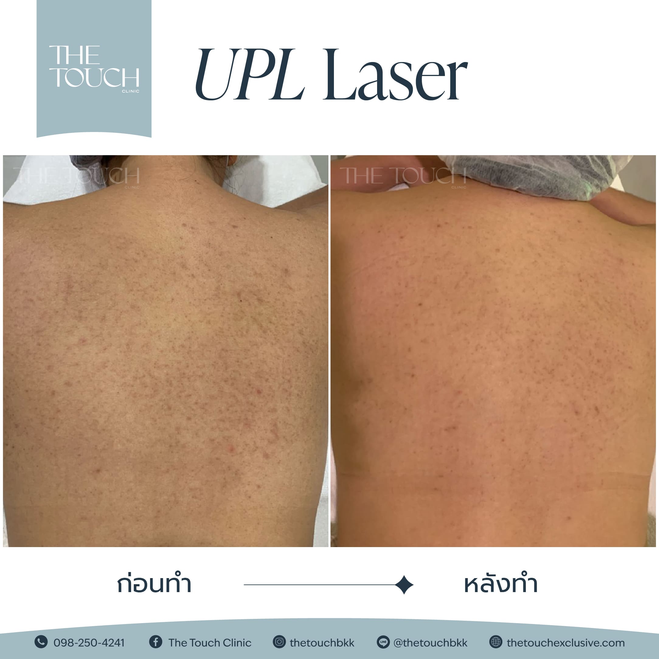 review-upl-ultimate-intensive-pulse-light