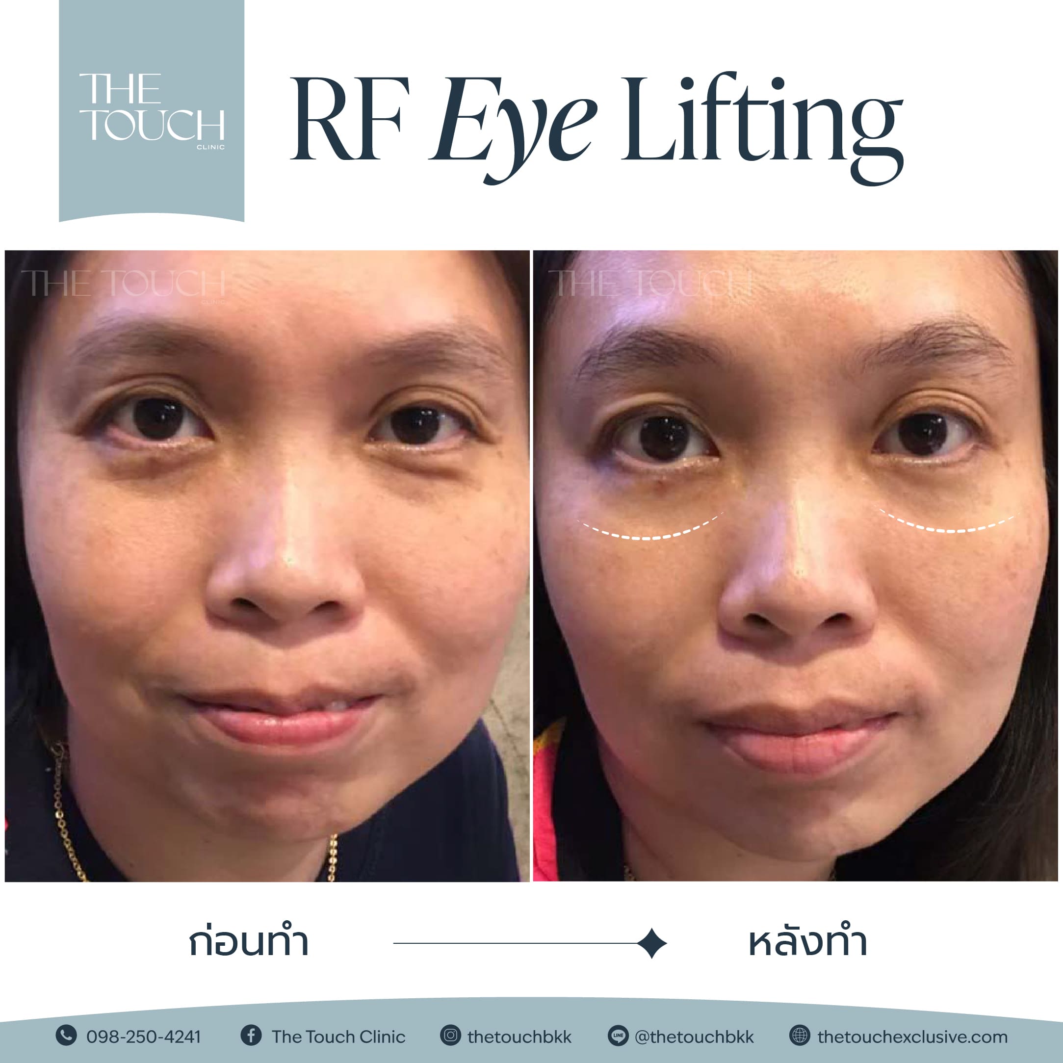 review-rf-eye-lifting