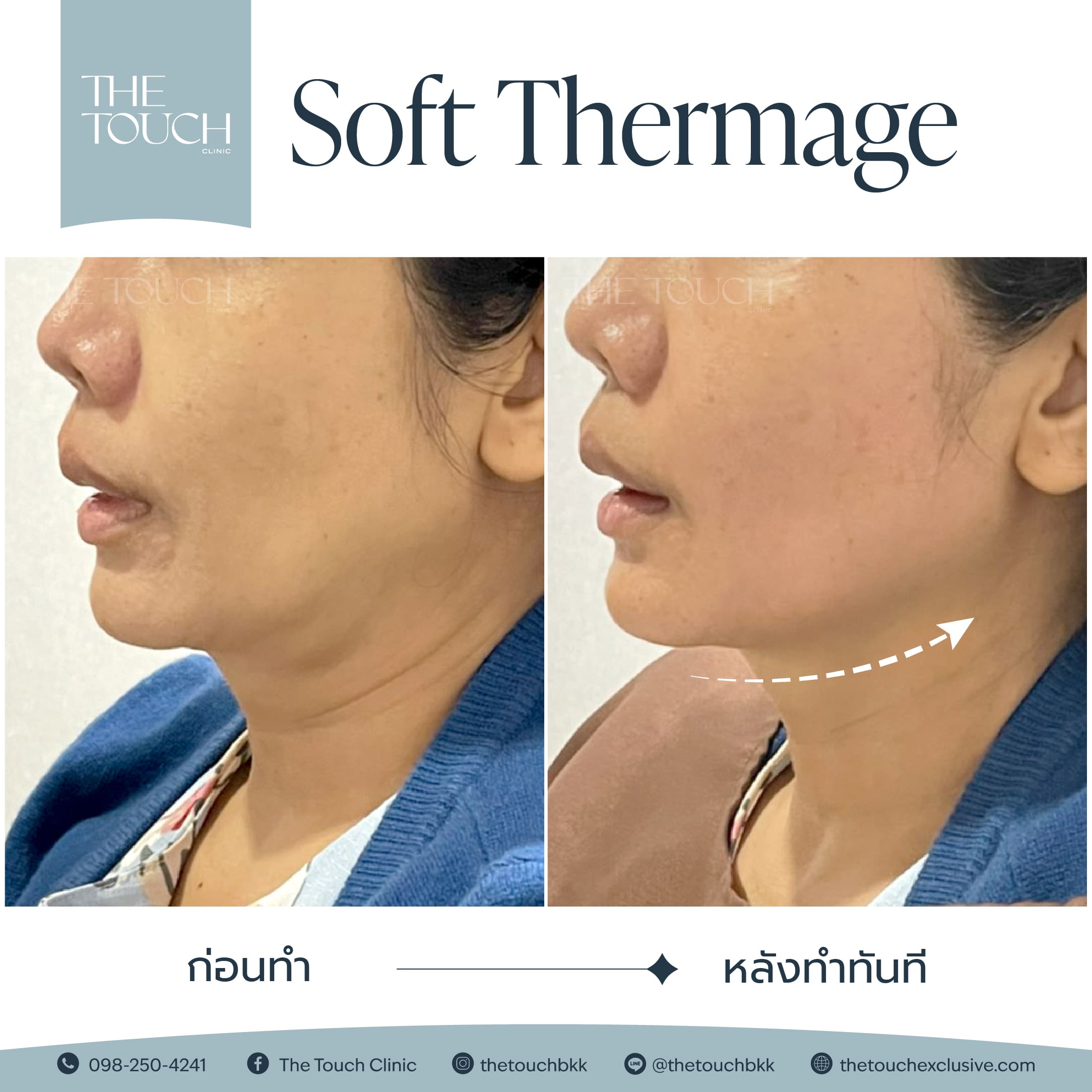 review-soft-thermage