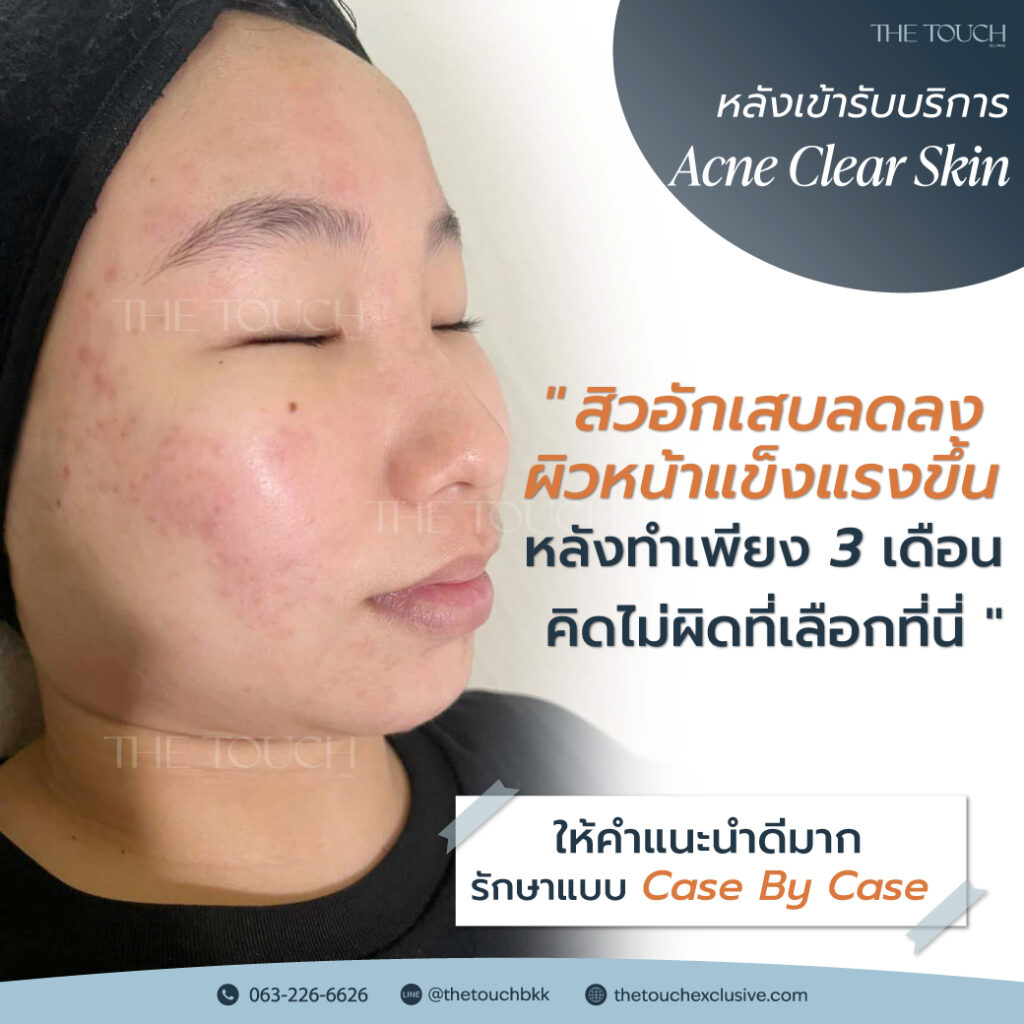 review-acne-clear-skin