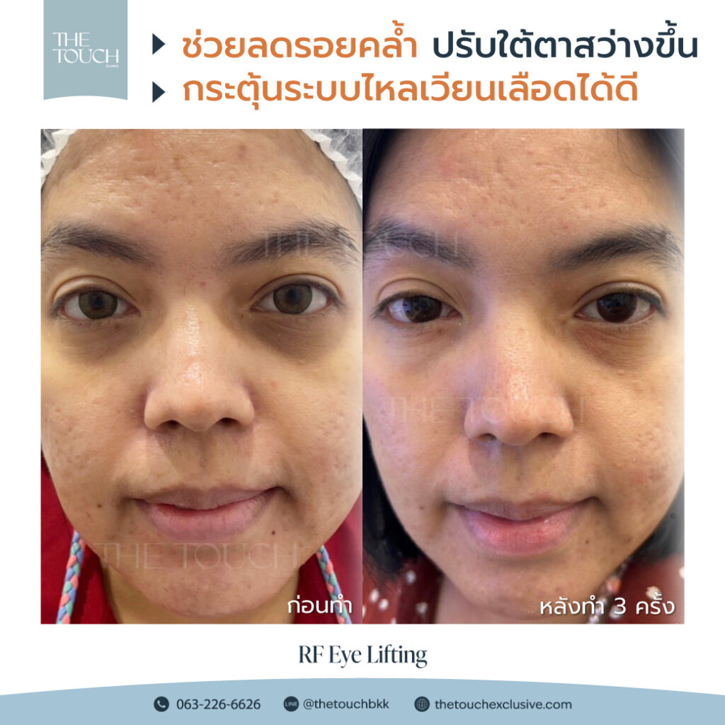 review-rf-eye-lifting