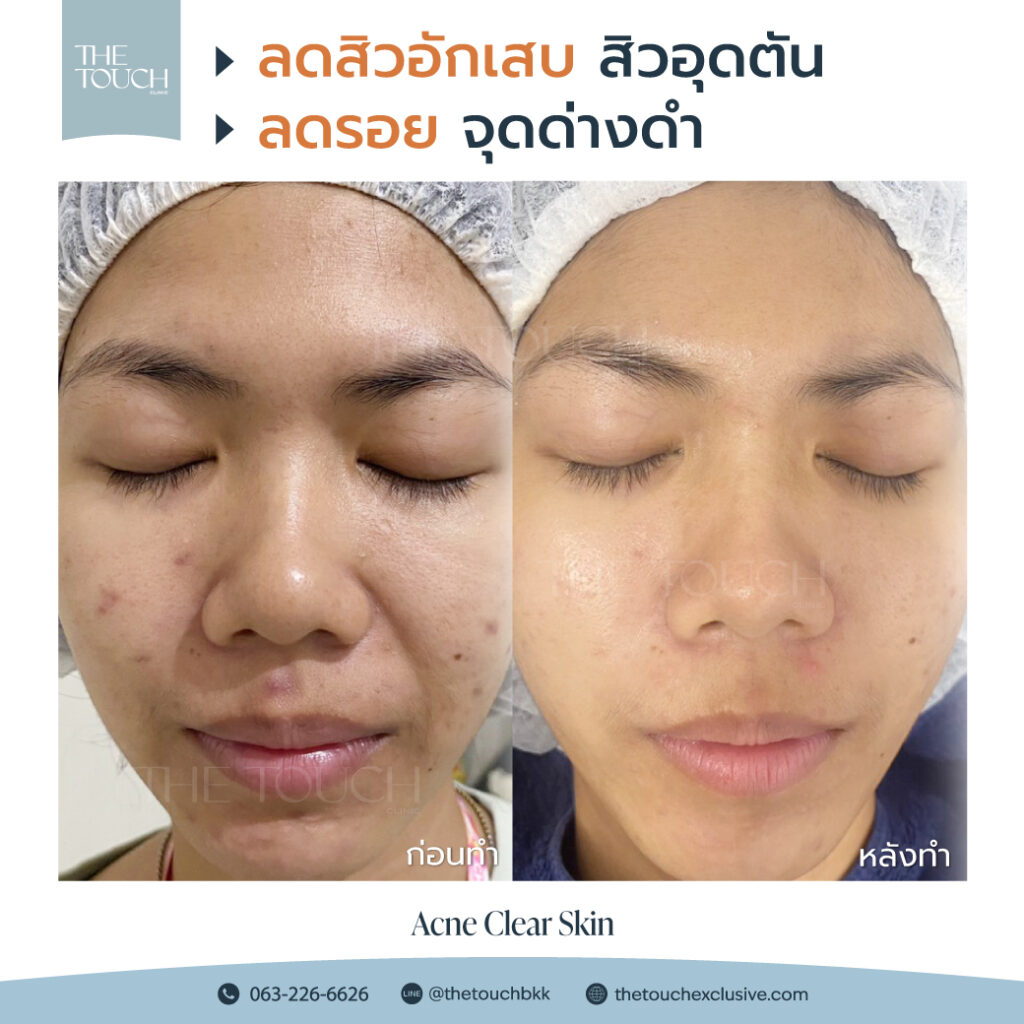 review-acne-clear-skin