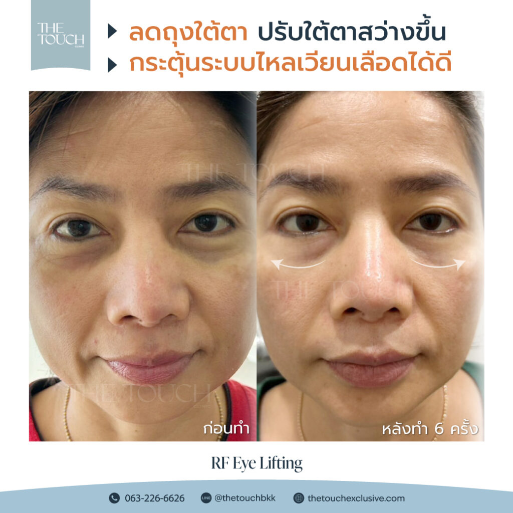 review-rf-eye-lifting