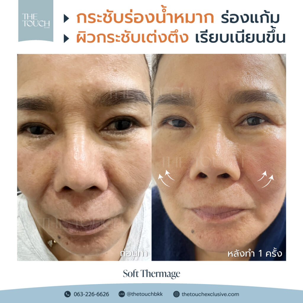 review-soft-thermage