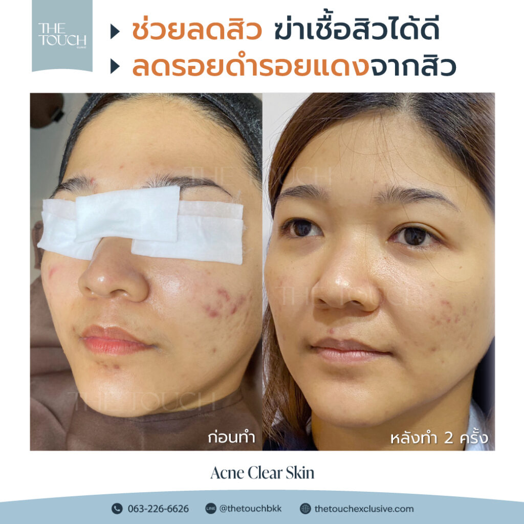 review-acne-clear-skin