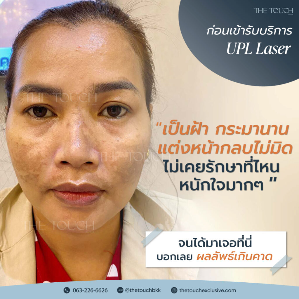 review-upl-ultimate-intensive-pulse-light