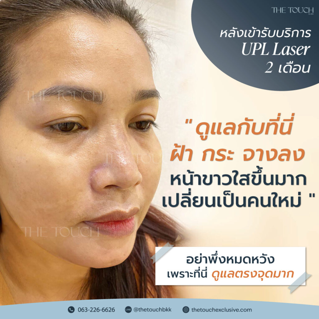 review-upl-ultimate-intensive-pulse-light