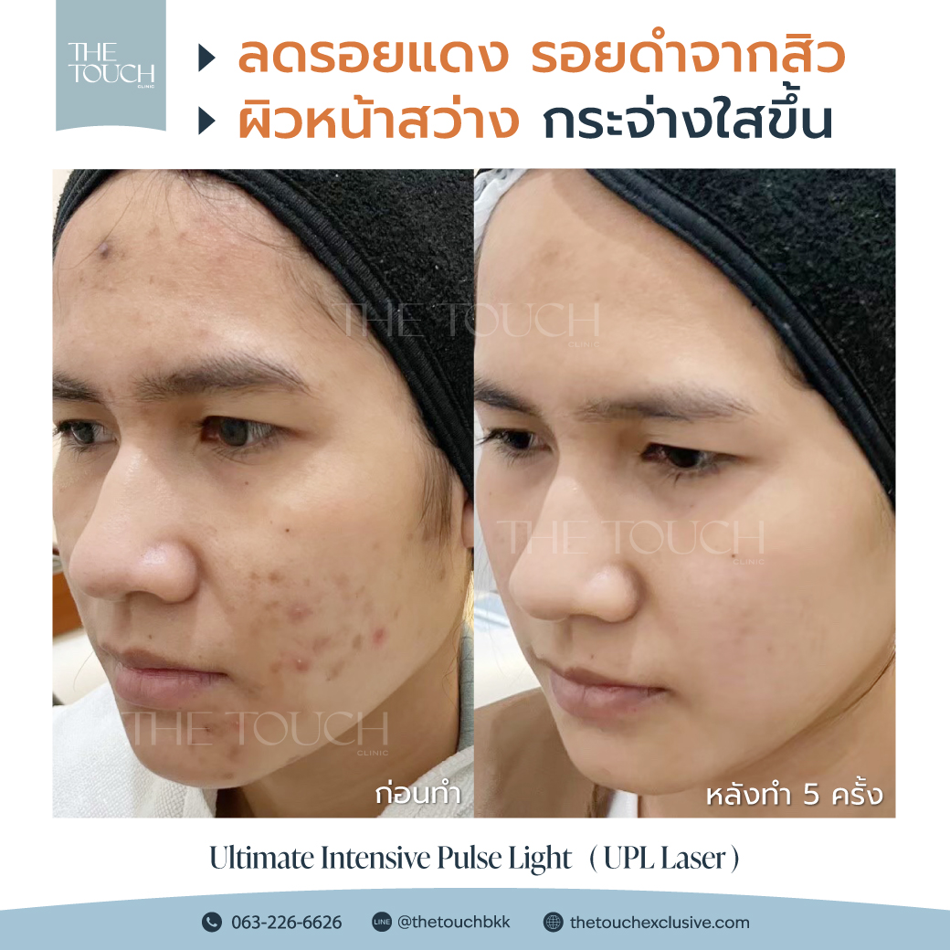 review-upl-ultimate-intensive-pulse-light