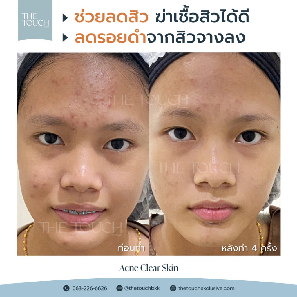 review-acne-clear-skin