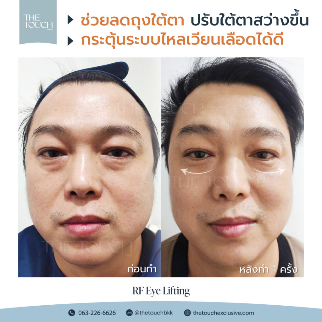 review-rf-eye-lifting