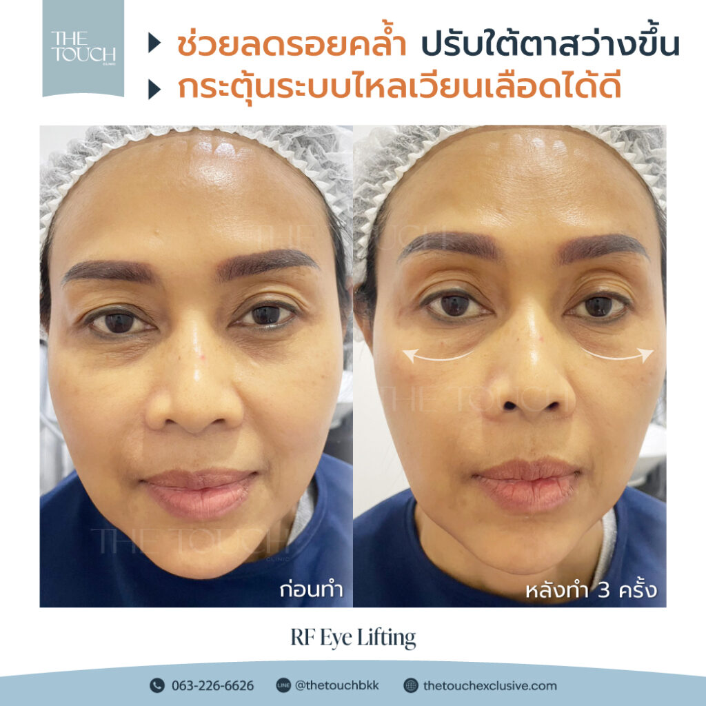 review-rf-eye-lifting