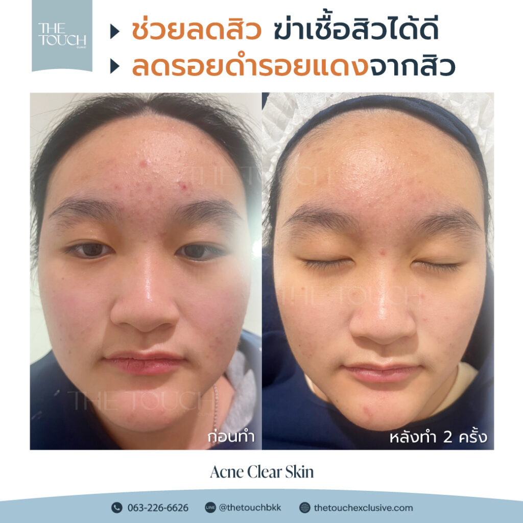 review-acne-clear-skin
