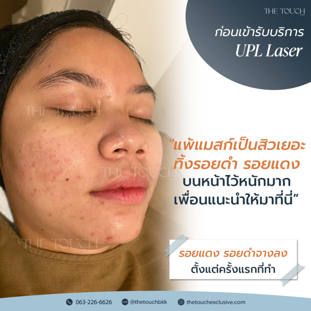 review-upl-ultimate-intensive-pulse-light