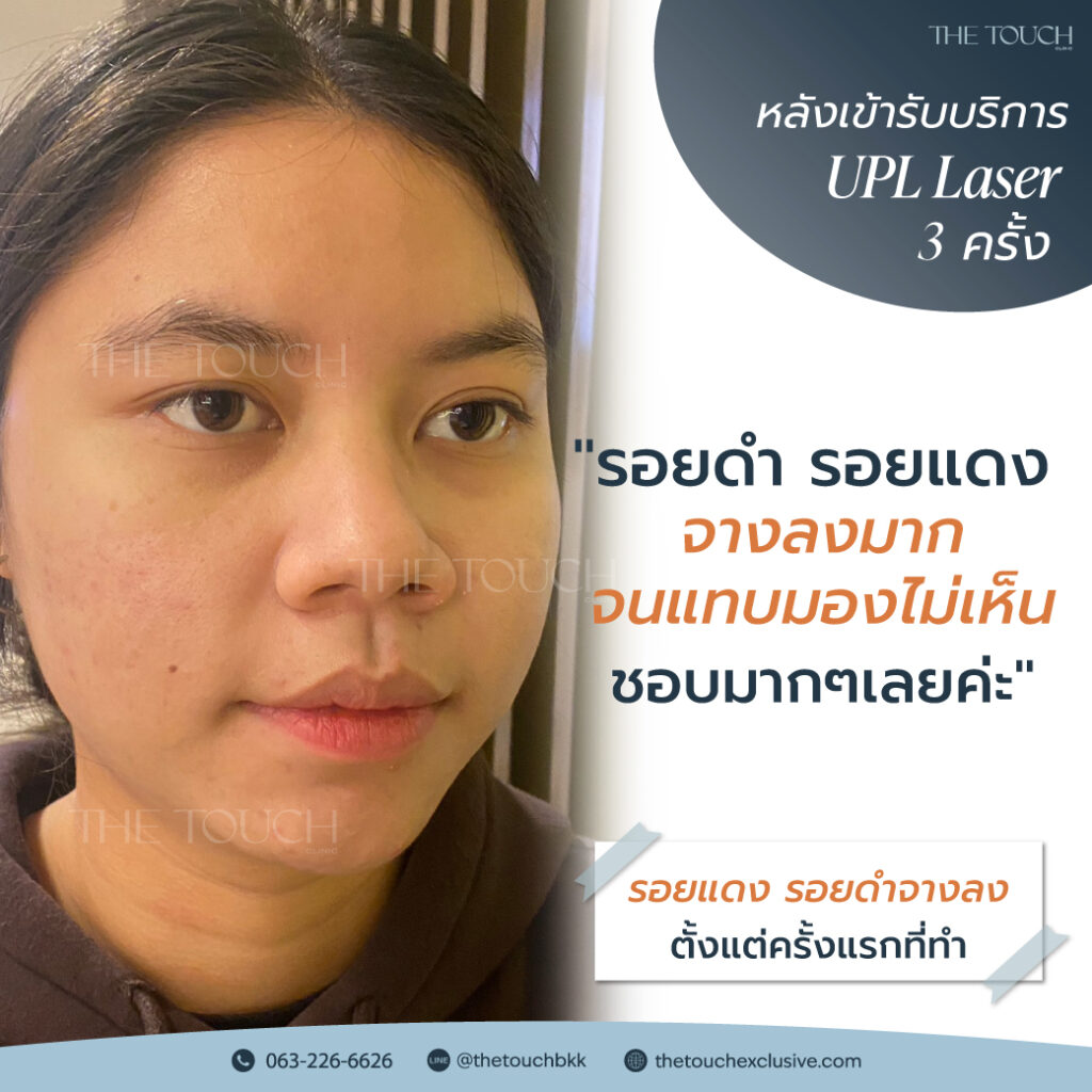 review-upl-ultimate-intensive-pulse-light