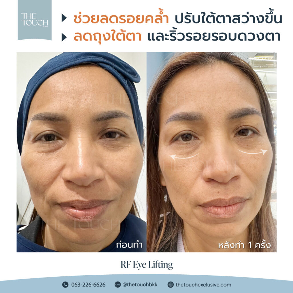 review-rf-eye-lifting