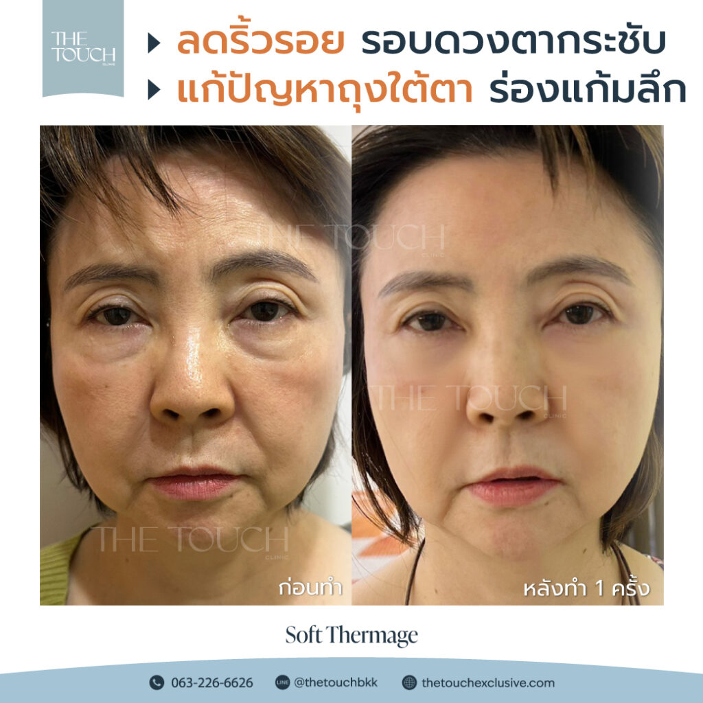 review-soft-thermage