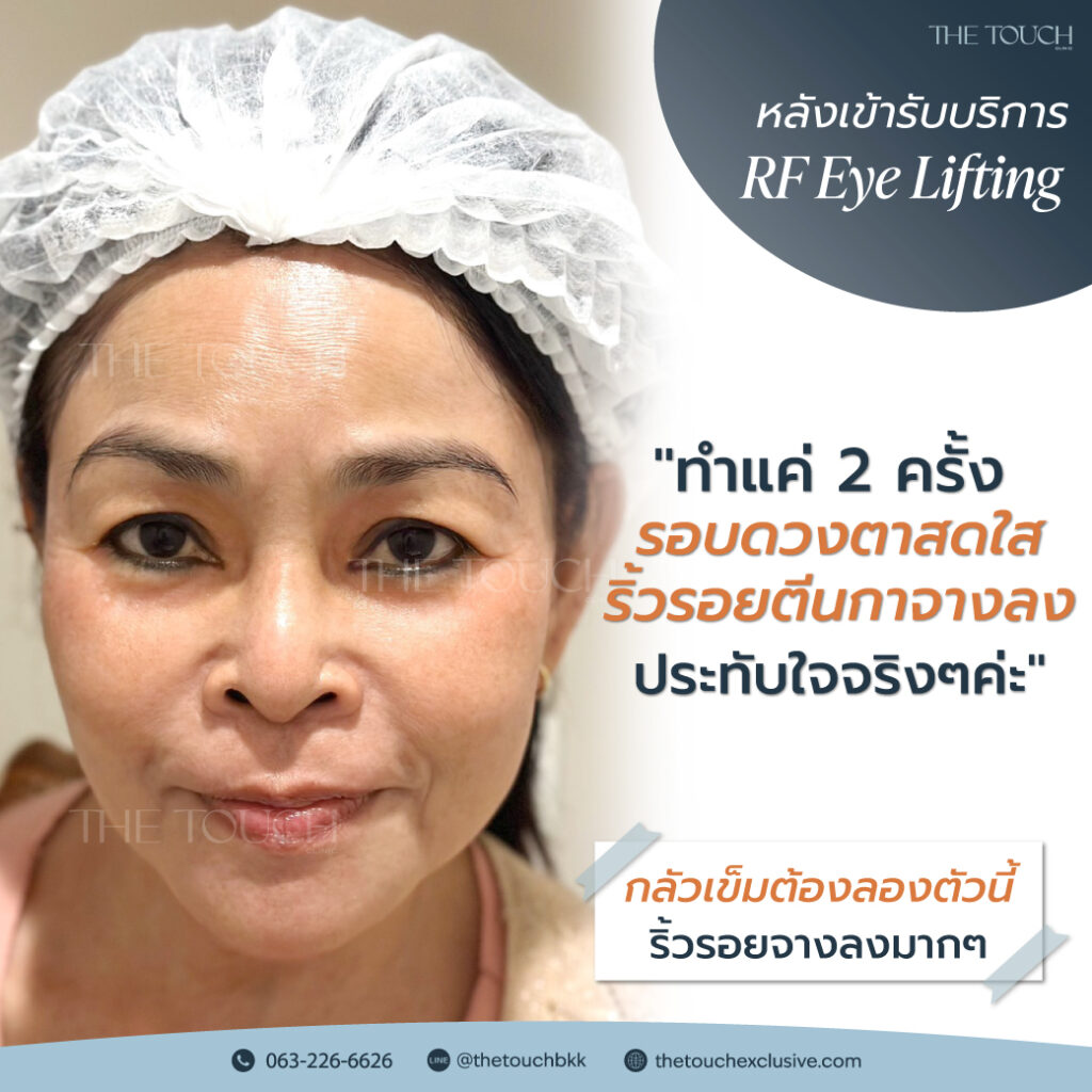 review-rf-eye-lifting