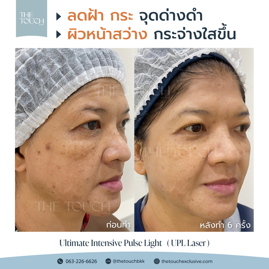 review-upl-ultimate-intensive-pulse-light