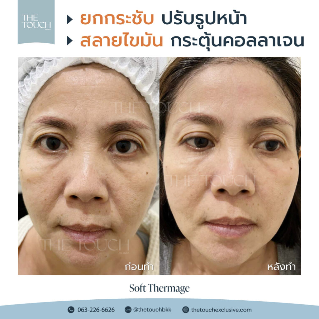 review-soft-thermage