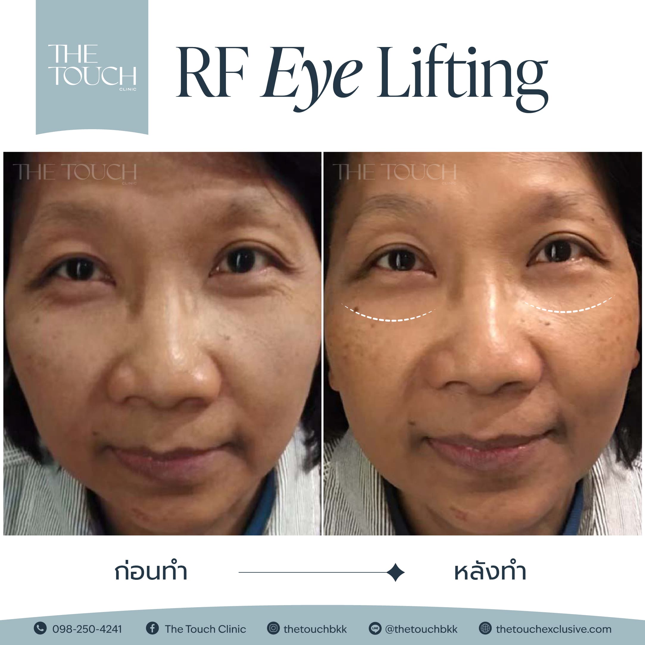 review-rf-eye-lifting