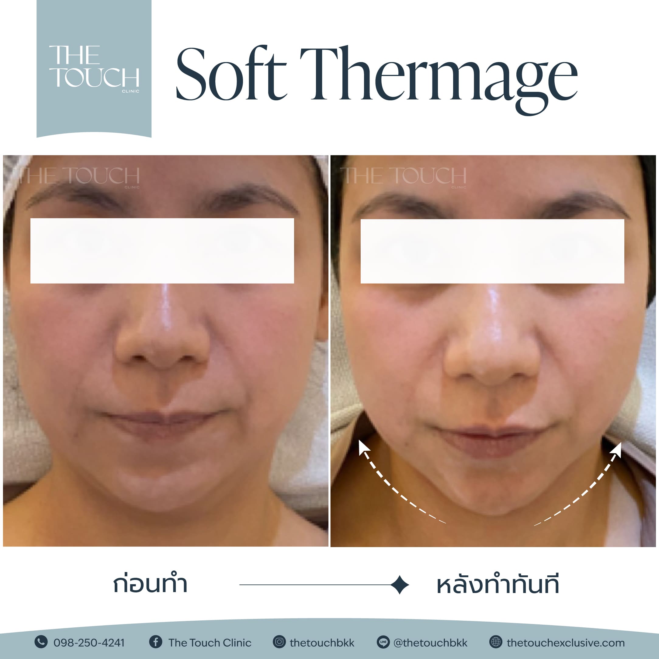 review-soft-thermage