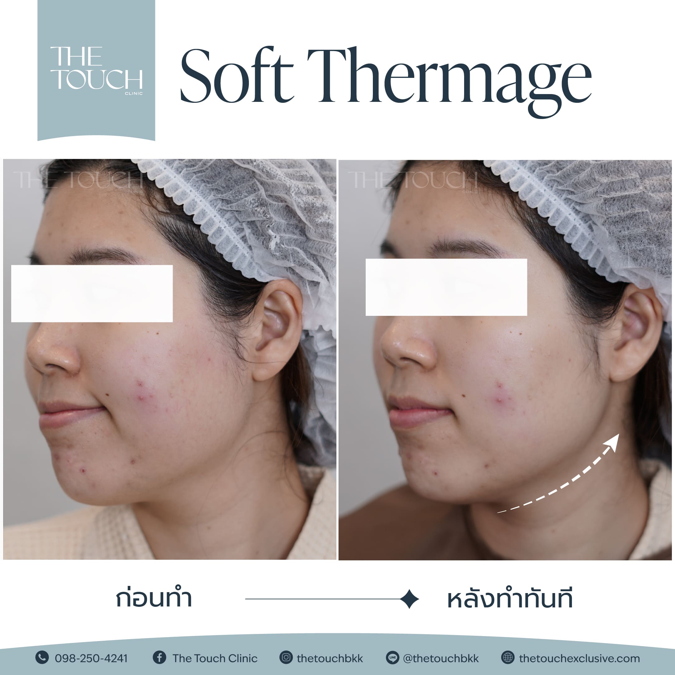 review-soft-thermage
