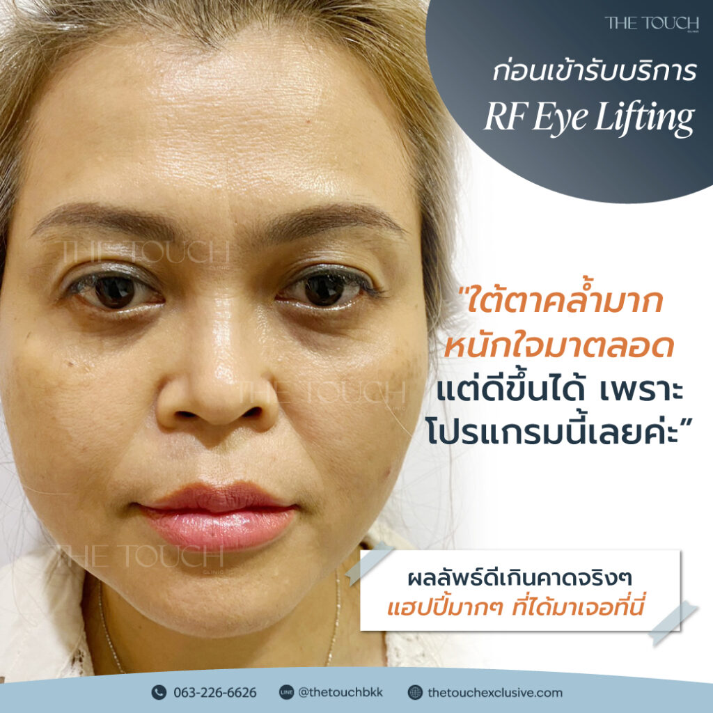 review-rf-eye-lifting