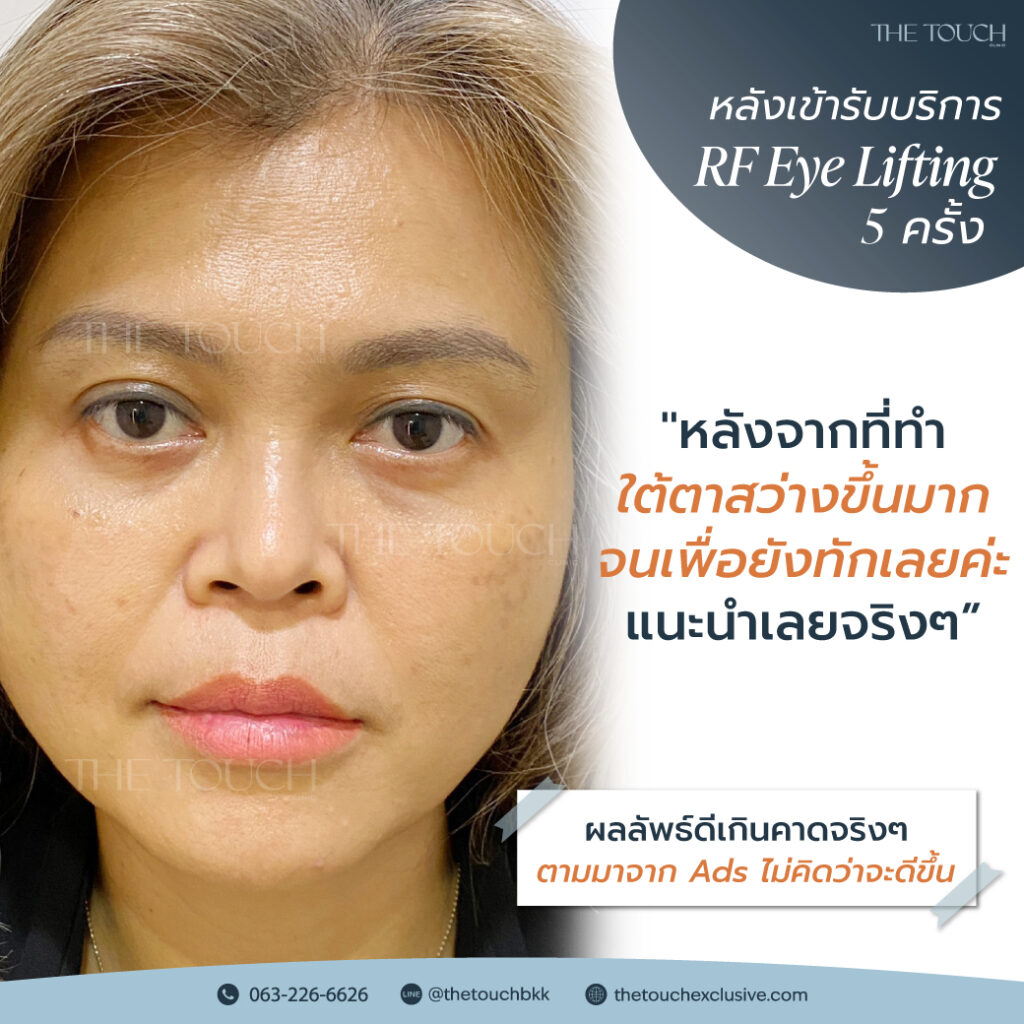 review-rf-eye-lifting