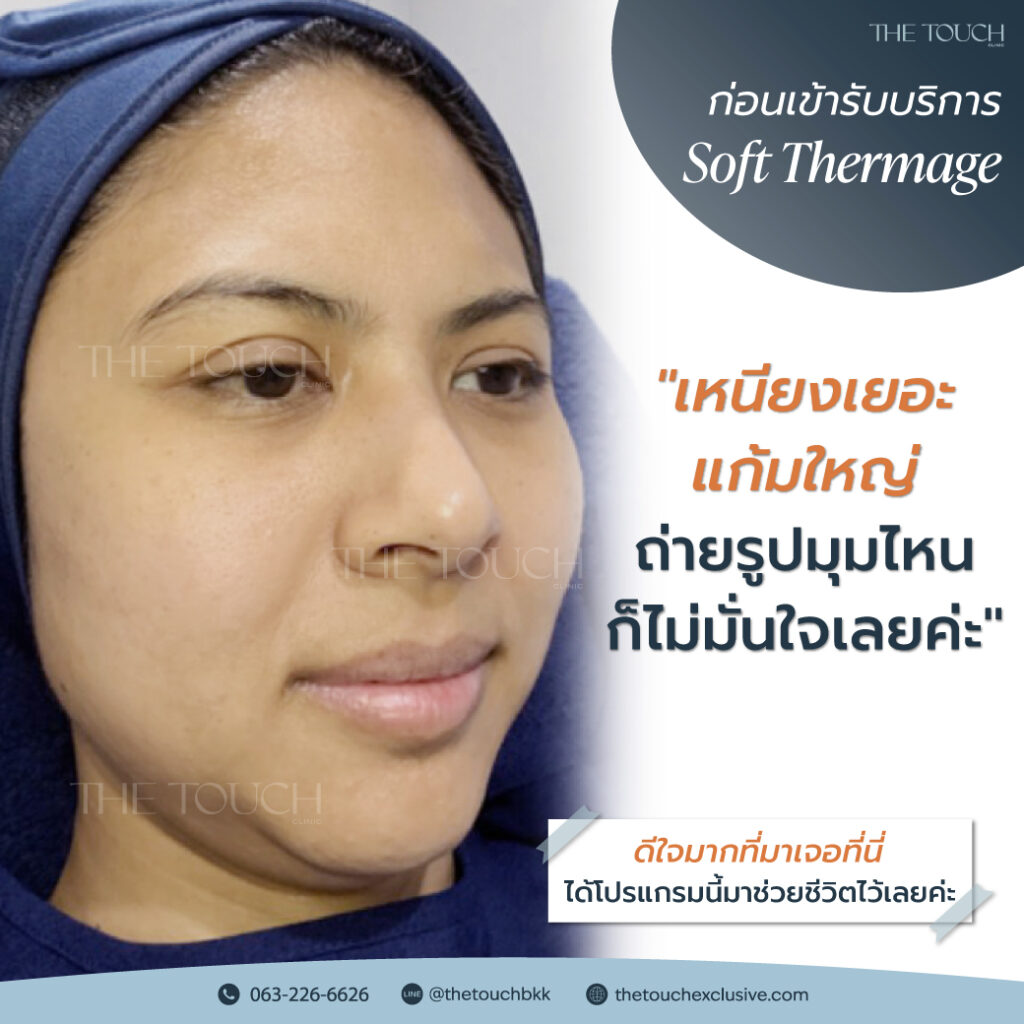 review-soft-thermage