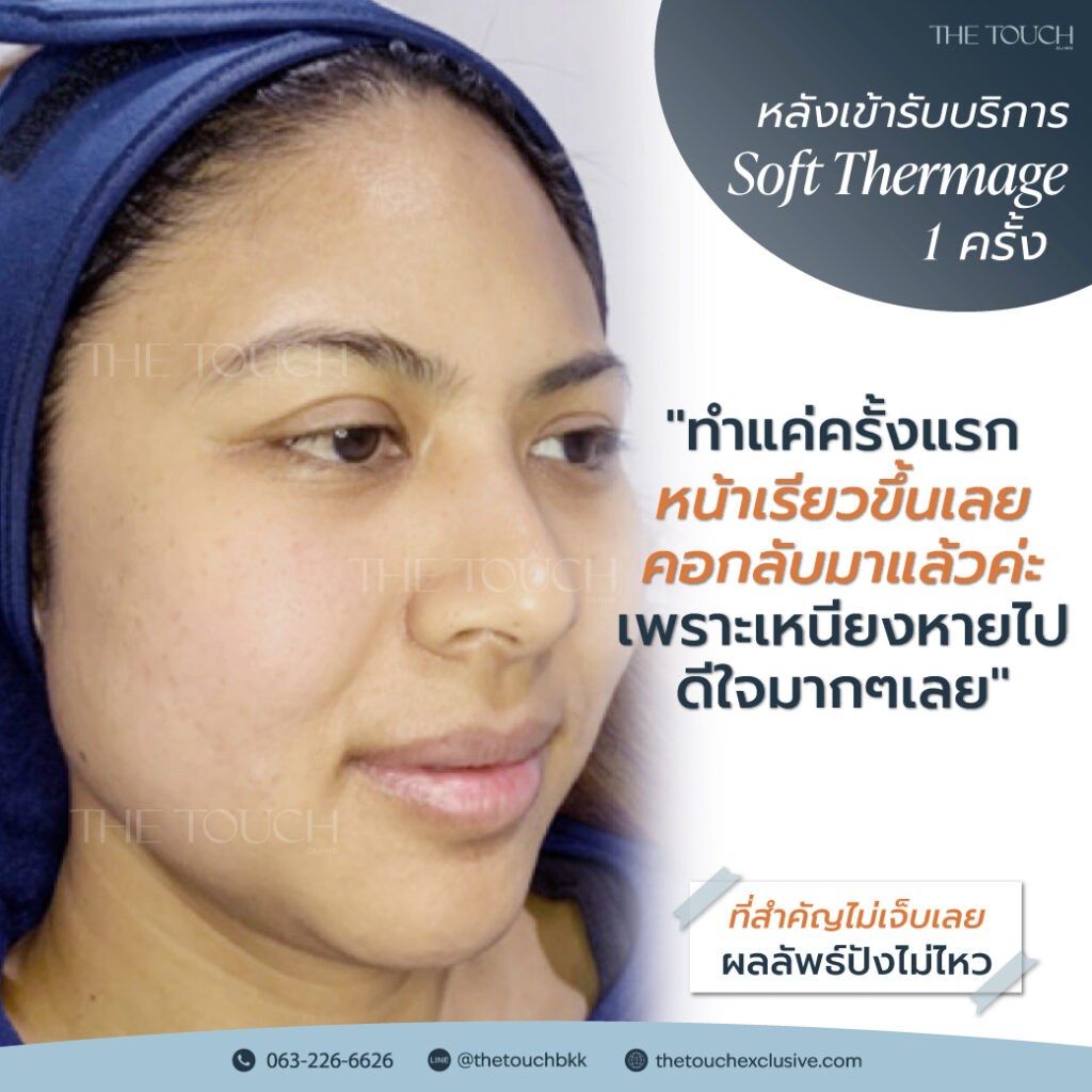 review-soft-thermage